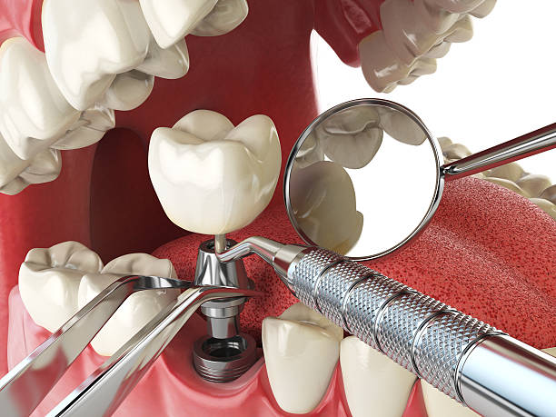 Best Emergency Dental Extractions in Red Springs, NC